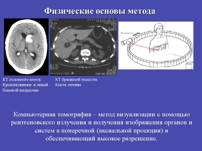 Физические основы метода КТ головного мозга. Кровоизлияние в левый боковой желудочек КТ брюшной полости.